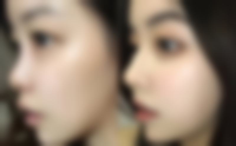 我在深圳今喜医疗美容门诊找曹孟君做1.55万富贵包手术，效果惊艳到我了！ 