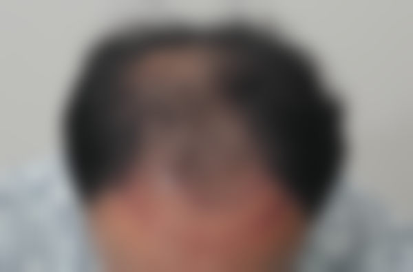 七、韩国JJ毛发移植医院价格表：（仅供参考）