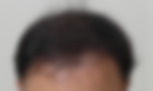 五、韩国JJ毛发移植医院实例