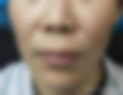 金岘进玻尿酸填充水平怎么样可靠吗？