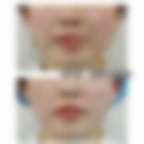 金岘进玻尿酸填充实例