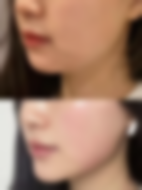 张玉芬皮肤修复实例