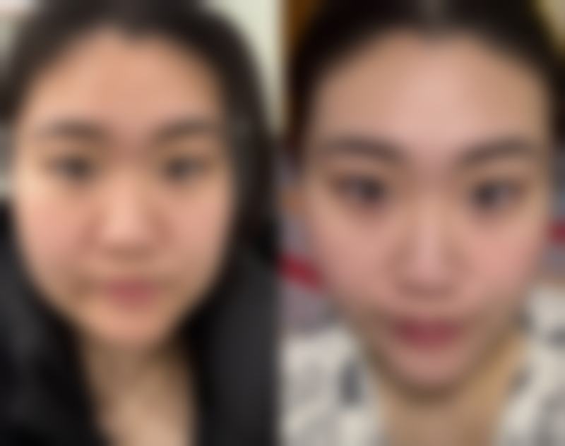 翟跃中面部整形实例