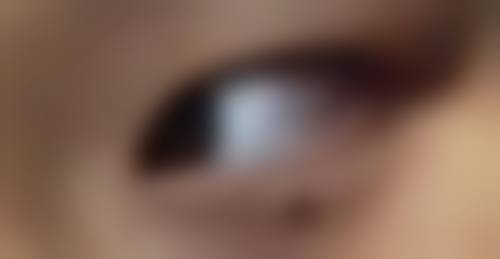 割双眼皮拆线前如何精心护理？适当冷敷热敷是加速修复秘诀