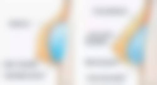 割双眼皮拆线前如何精心护理？合理饮食是促进修复秘诀