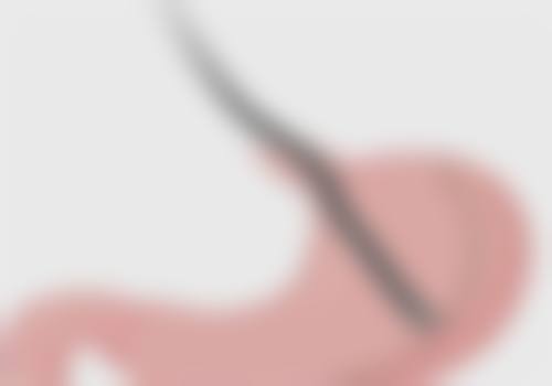 内双变双眼皮：非手术的小妙招