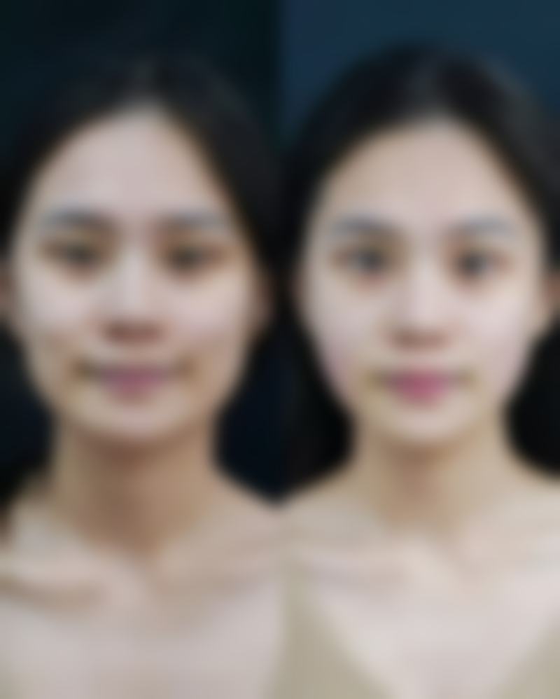 内双变双眼皮：手术方案大揭秘