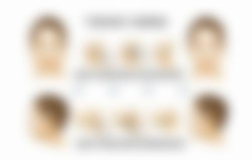 一只双眼皮成因大揭秘之成熟技术改善美观