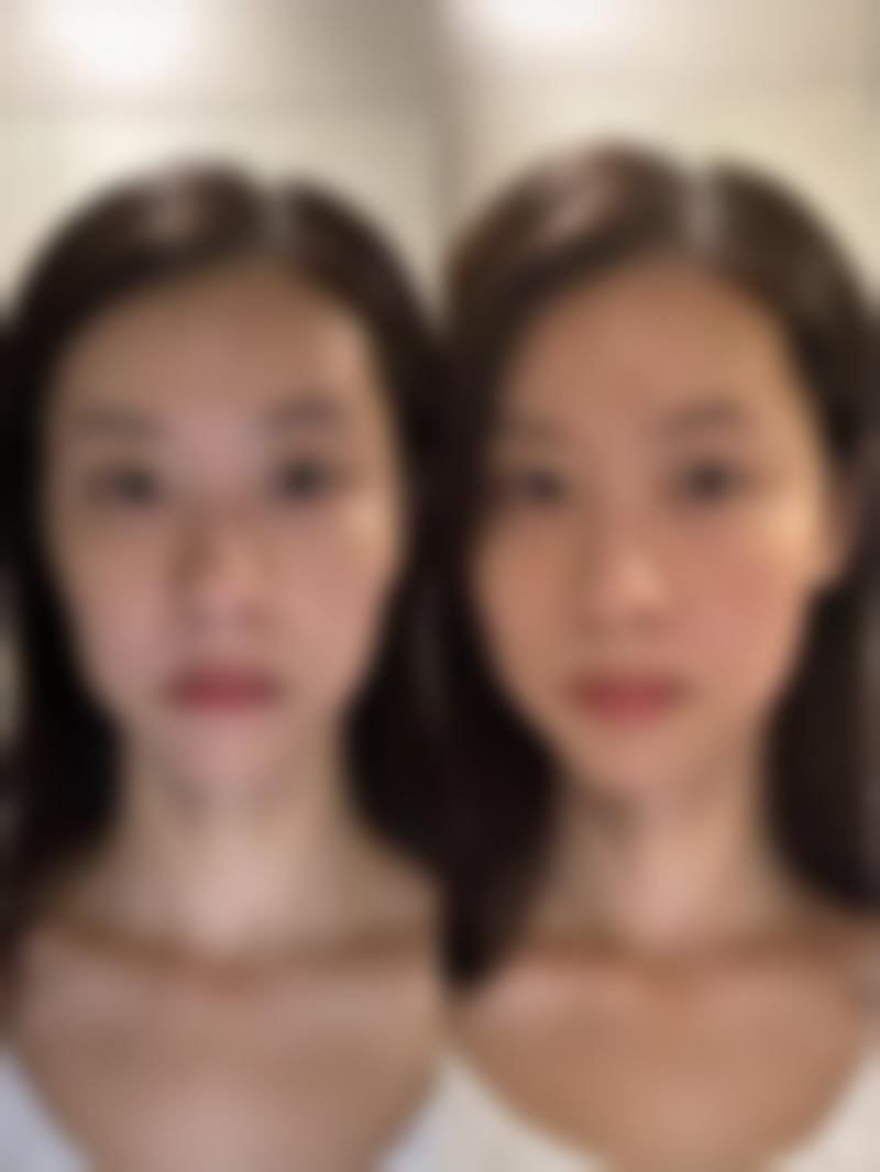 面部青春痘疤痕怎么治疗？选对专精医院特别重要