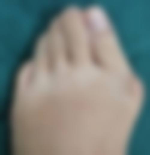 天生的下眼袋怎么消除？轻医美与手术方案结合，助你长效摆脱眼袋困扰 