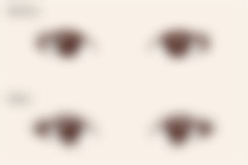 7.5毫米双眼皮，开启精致美丽新旅程！