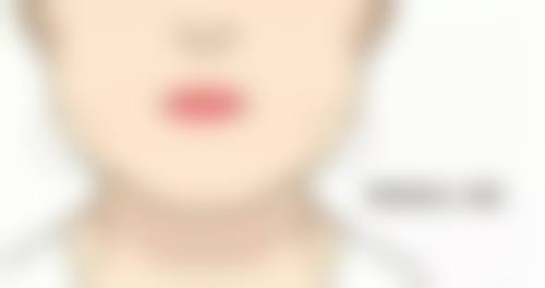 正规医院做7.5毫米双眼皮，安心又有保护！