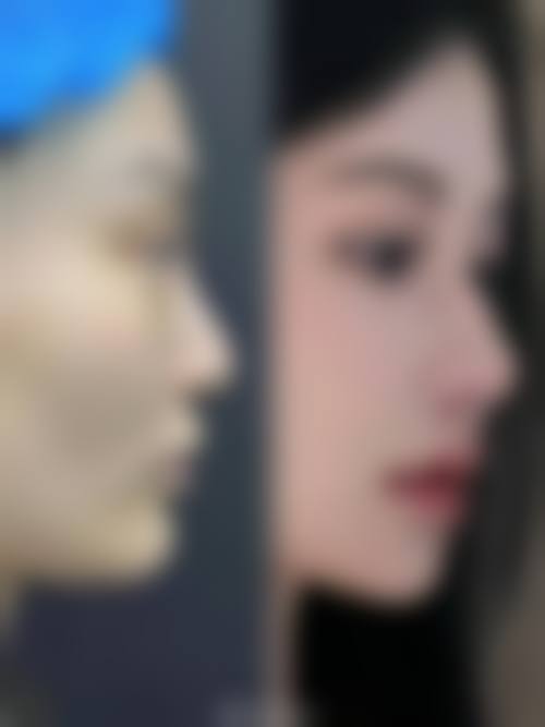 张会堂鼻再造水平怎么样可靠吗？