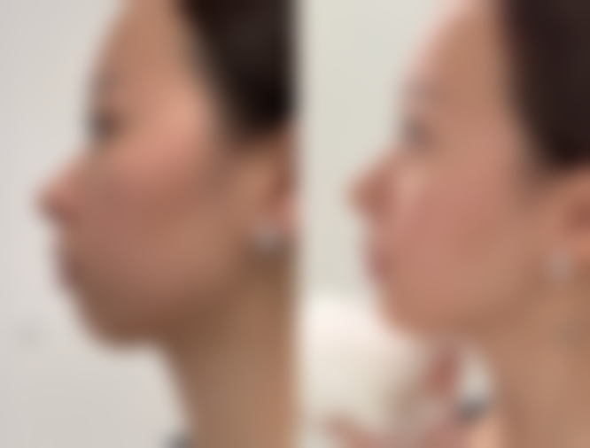 如何打造效果绝佳的双眼皮？结合眼部美学设计与精细技术是关键秘诀 