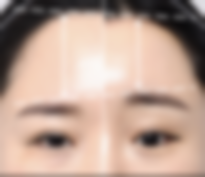 疤痕疙瘩能否长平？坚持就是胜利