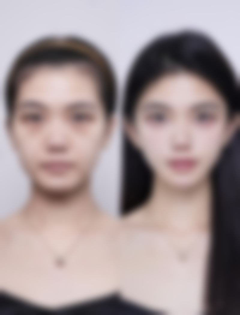 疤痕疙瘩能否长平？正规医院多疗法综合施治，助您实现肌肤平整梦想 