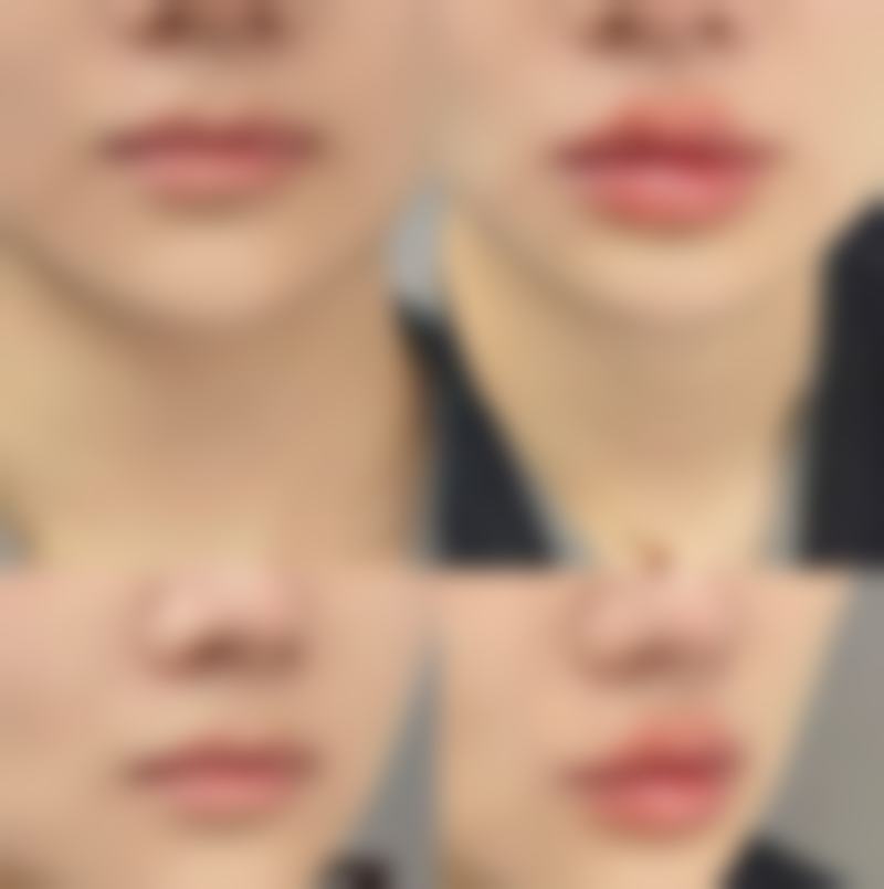 天生的下眼袋怎么去除？手术方案显神通