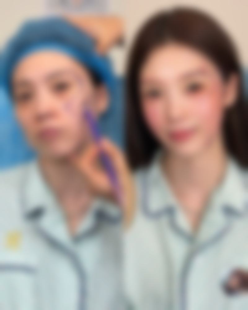 正规医院改善三眼皮的方法