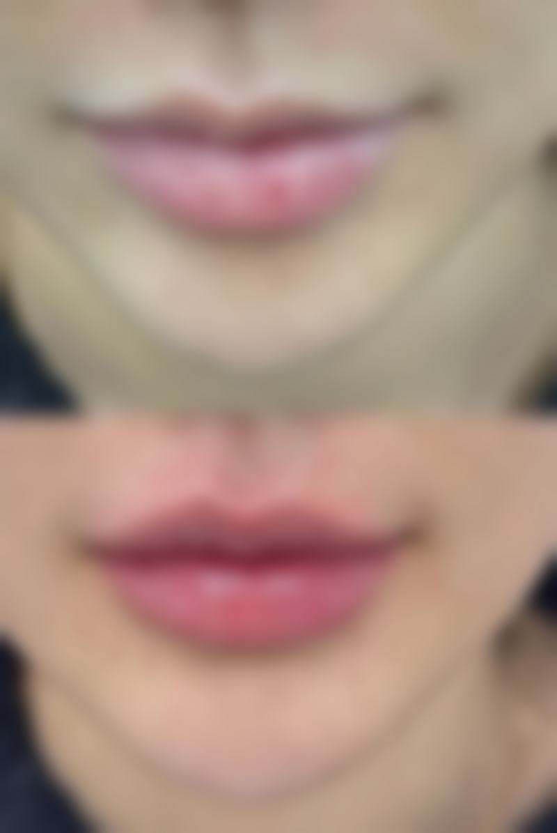 宝宝脸上冻疮疤痕怎么去除？针对性处理有妙招