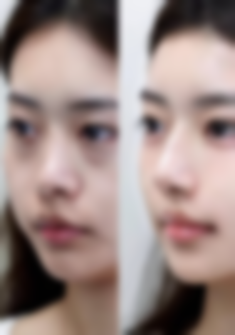 切痣疤痕修复的注意事项