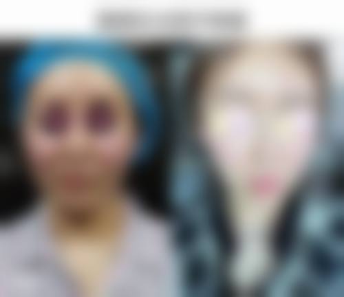 张会堂鼻再造实例