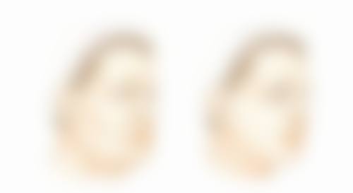 德国热效溶脂去眼袋技术，术后注意事项有哪些？