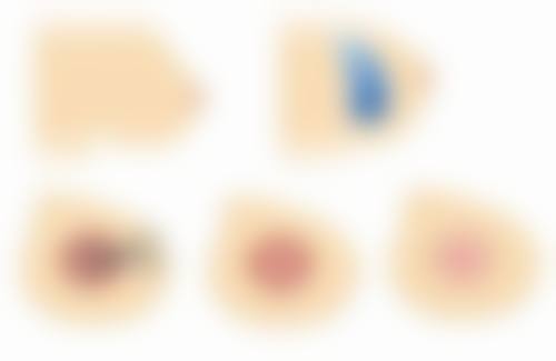 正规医美机构帮你告别顽固眼袋