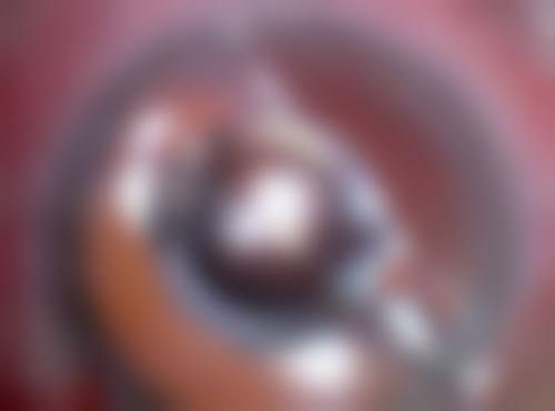 割双眼皮后肿得厉害莫急！警惕异常情况及时就医