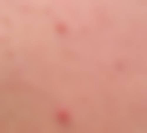 李灵玲激光治疗痤疮疤痕实例