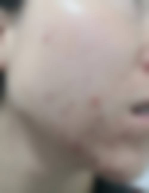 李灵玲激光治疗痤疮疤痕项目价格表参考