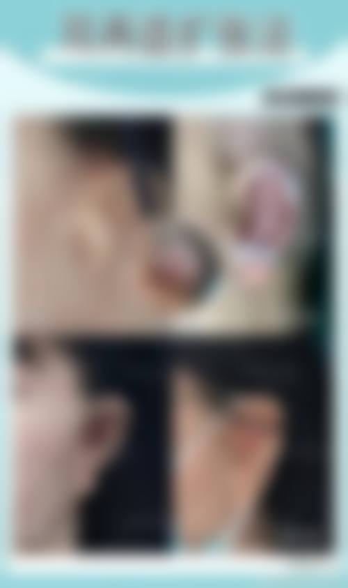 张会堂鼻再造实例