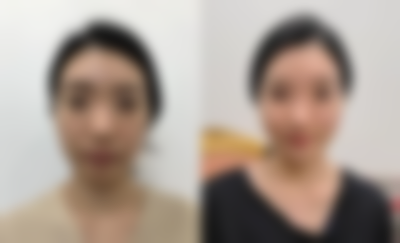 马战胜眼部整形实例