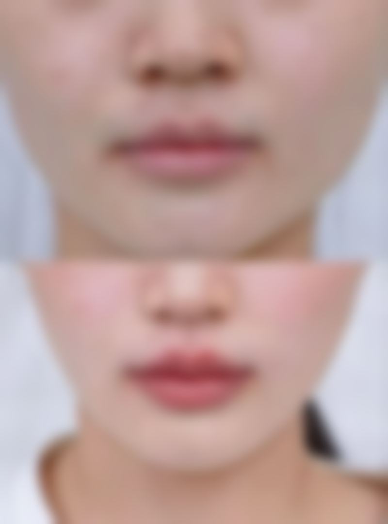 割双眼皮全流程注意要点大揭秘，术前设计、术后护理与恢复周期管理全知晓