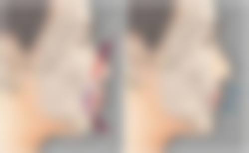 揭秘除皱针注意事项：术前选药与术后护理要点，保障自然年轻化效果 