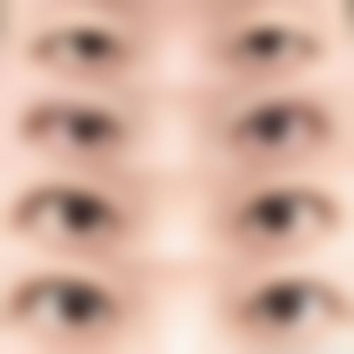 马战胜眼部整形实例