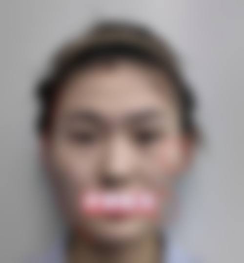 何泽星面部整形实例