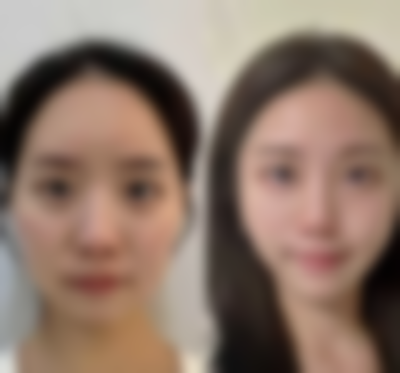 理性看待瘦脸针成效，追求自然美