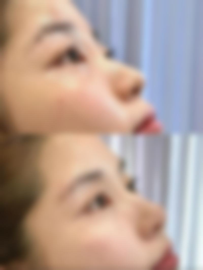 瘦脸针效果非永久，一般维持4 - 12个月，教你多招延长效果并选个性化方案 