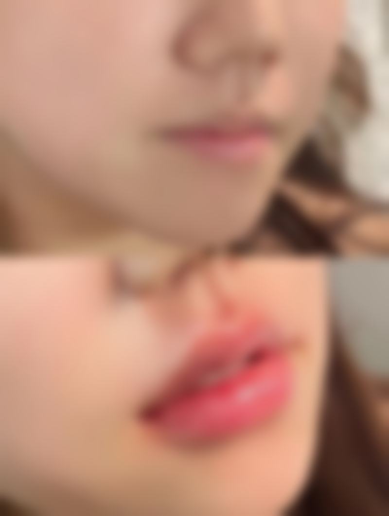 肋骨隆鼻恢复时间大揭秘！一般3 - 6个月正常，6 - 12个月完全自然