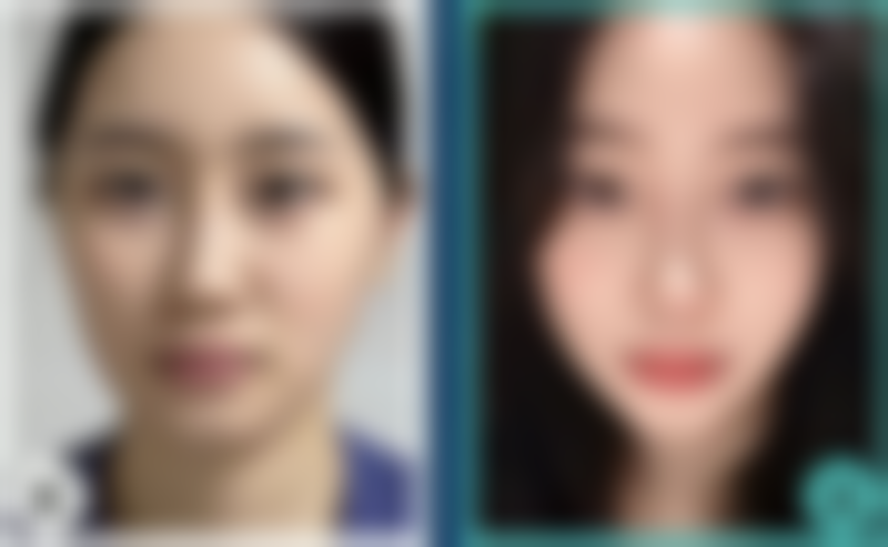 夏天割眼袋，轻松拥有明亮双眸