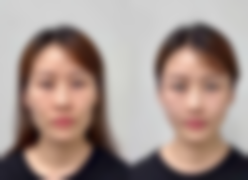 20年前埋线双眼皮，拆与不拆看眼部状态，专业评估助您重获灵动美眼 