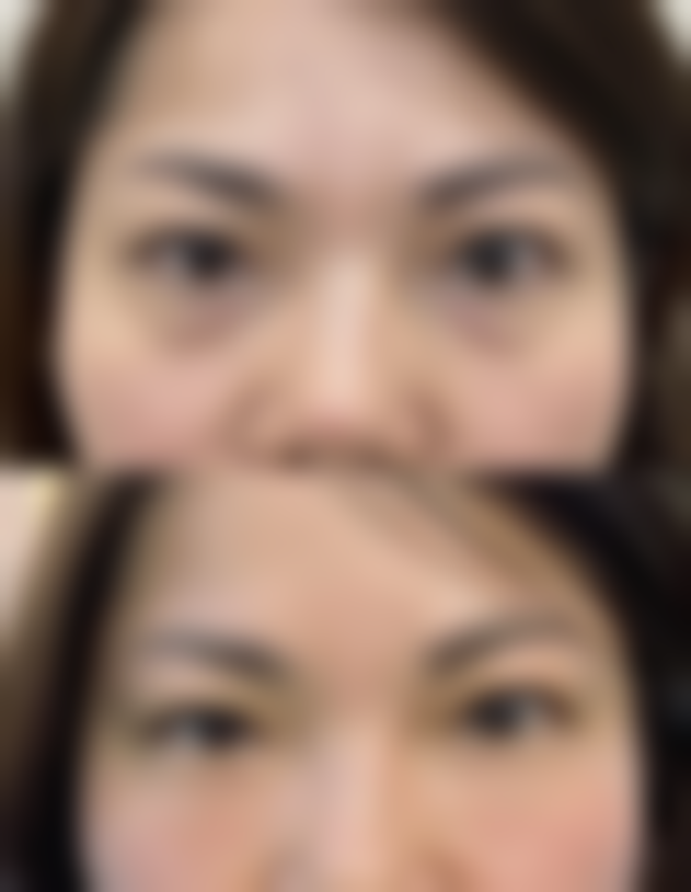 除眼袋最安全最好的方法揭秘：个性化方案结合多途径，有效抗衰焕亮眼眸 