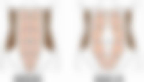 美杜莎双眼皮的术后成效咋样？真实实例来说话