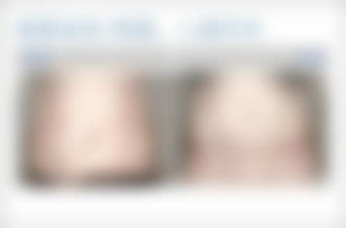 告别疤痕色素沉着难题！基础护理，打好消除色素的第一仗