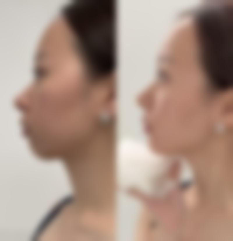 还在担心疤痕黑色素难除？专精医院常见治疗方法揭秘