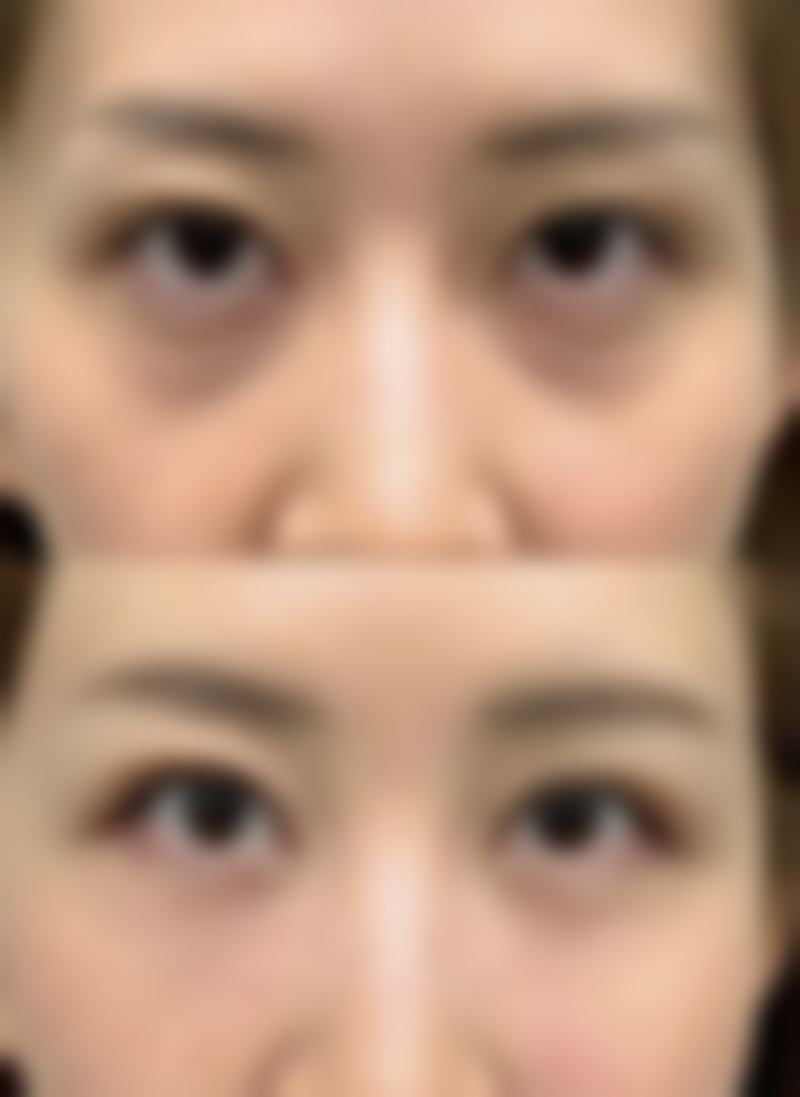 选择合适的咖啡,助力双眼皮修复