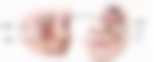 溶脂针消除眼袋的过程和术后护理是怎样的?