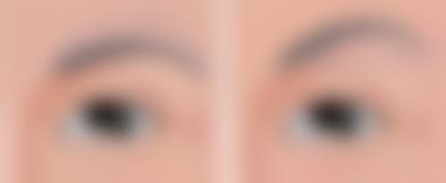 溶脂针消除眼袋的优势有哪些?