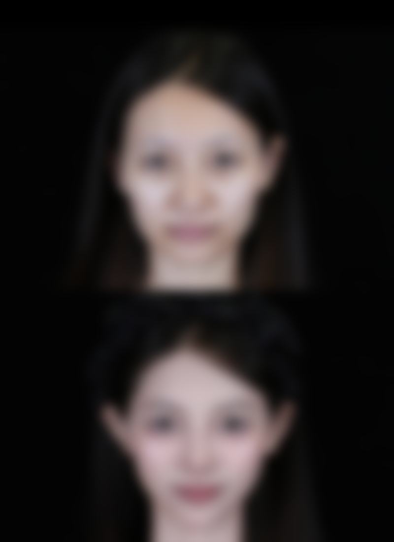 熬夜后眼袋难消？选择医美医院要谨慎