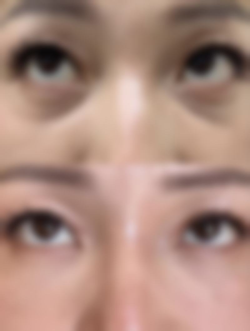 熬夜后眼袋难消？日常注意事项不能忘